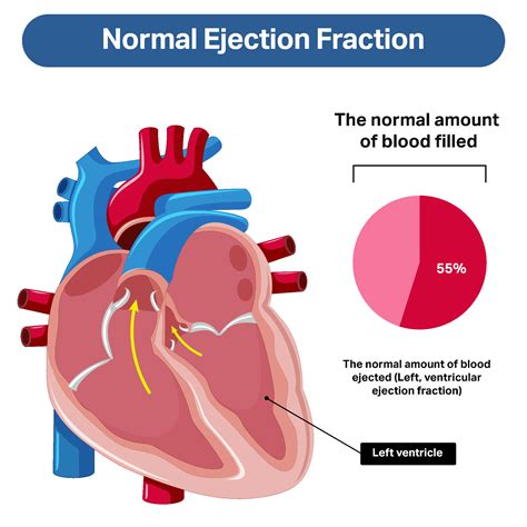 severe hypokinesis|ejection fraction heart failure chart.